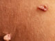 Is There a Skin Tag Removal Toothpaste? Is There a Skin Tag Removal Toothpaste?