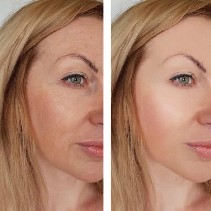 Tranexamic Acid for Skin: Everything You Need to Know Tranexamic Acid for Skin: Everything You Need to Know
