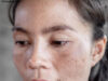 Best Treatment for Melasma on Face Best Treatment for Melasma on Face