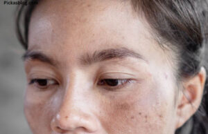 Best Treatment for Melasma on Face Best Treatment for Melasma on Face