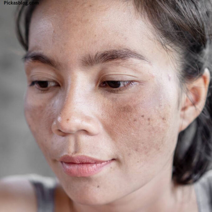 Best Treatment for Melasma on Face Best Treatment for Melasma on Face