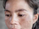 Best Treatment for Melasma on Face Best Treatment for Melasma on Face