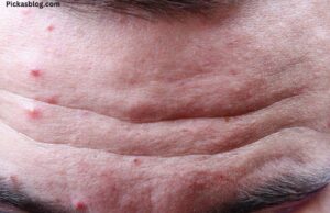 Causes of Pimples on Face in Adults. Causes of Pimples on Face in Adults