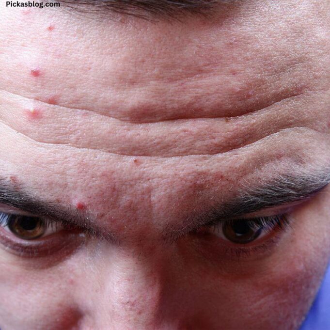 Causes of Pimples on Face in Adults. Causes of Pimples on Face in Adults