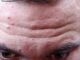 Causes of Pimples on Face in Adults. Causes of Pimples on Face in Adults