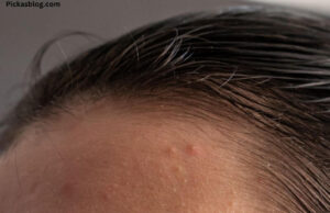 Home Remedies For Pimples Home Remedies For Pimples