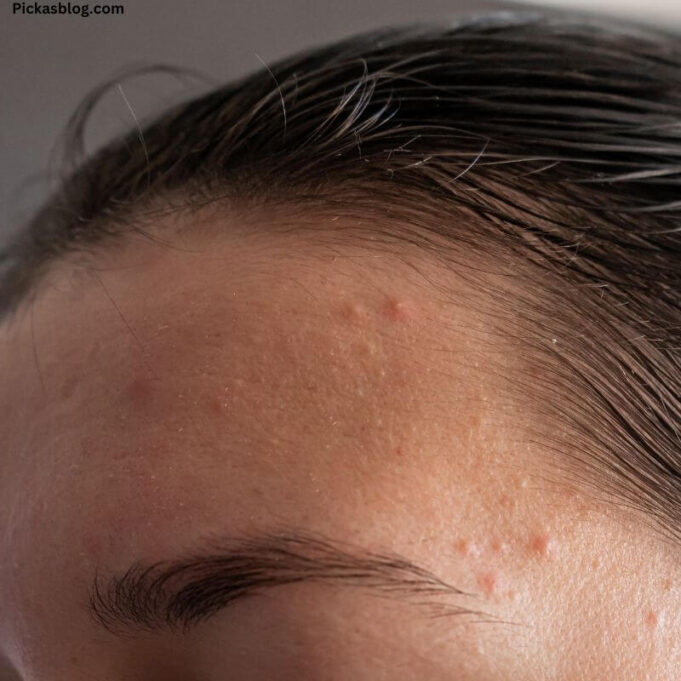 Home Remedies For Pimples Home Remedies For Pimples