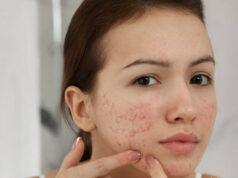 Home Remedies for Pimples Home Remedies for Pimples