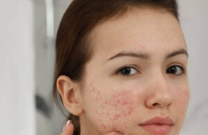 Home Remedies for Pimples Home Remedies for Pimples