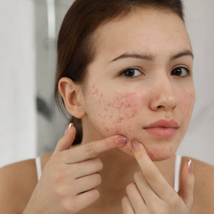 Home Remedies for Pimples Home Remedies for Pimples