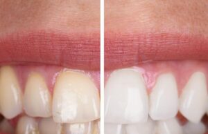 Home Remedies for Teeth Whitening Home Remedies for Teeth Whitening