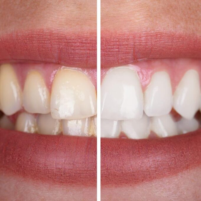Home Remedies for Teeth Whitening Home Remedies for Teeth Whitening