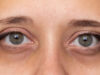 How to Get Rid of Eye Bags How to Get Rid of Eye Bags