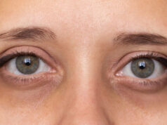 How to Get Rid of Eye Bags How to Get Rid of Eye Bags