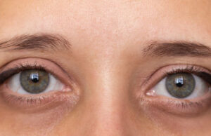 How to Get Rid of Eye Bags How to Get Rid of Eye Bags
