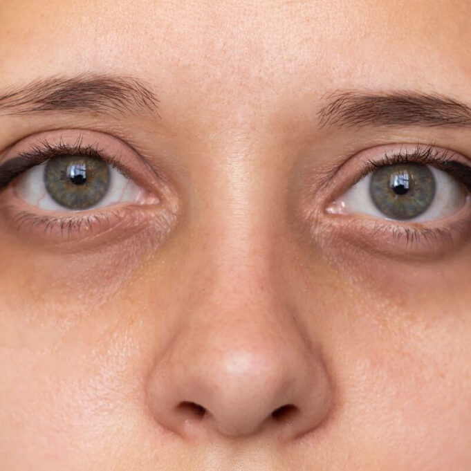 How to Get Rid of Eye Bags How to Get Rid of Eye Bags
