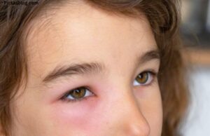 Swollen Face in the Morning: What Does it Mean? Swollen Face in the Morning: What Does it Mean?