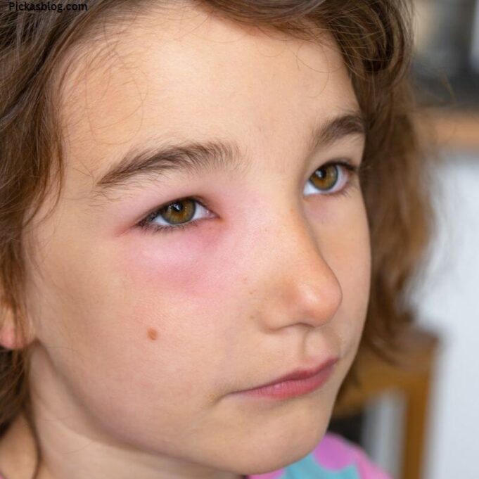 Swollen Face in the Morning: What Does it Mean? Swollen Face in the Morning: What Does it Mean?