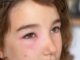 Swollen Face in the Morning: What Does it Mean? Swollen Face in the Morning: What Does it Mean?