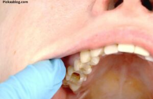How can I Stop Skin from Peeling Inside my Mouth? How can I Stop Skin from Peeling Inside my Mouth?