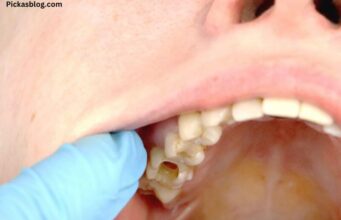 How can I Stop Skin from Peeling Inside my Mouth? How can I Stop Skin from Peeling Inside my Mouth?