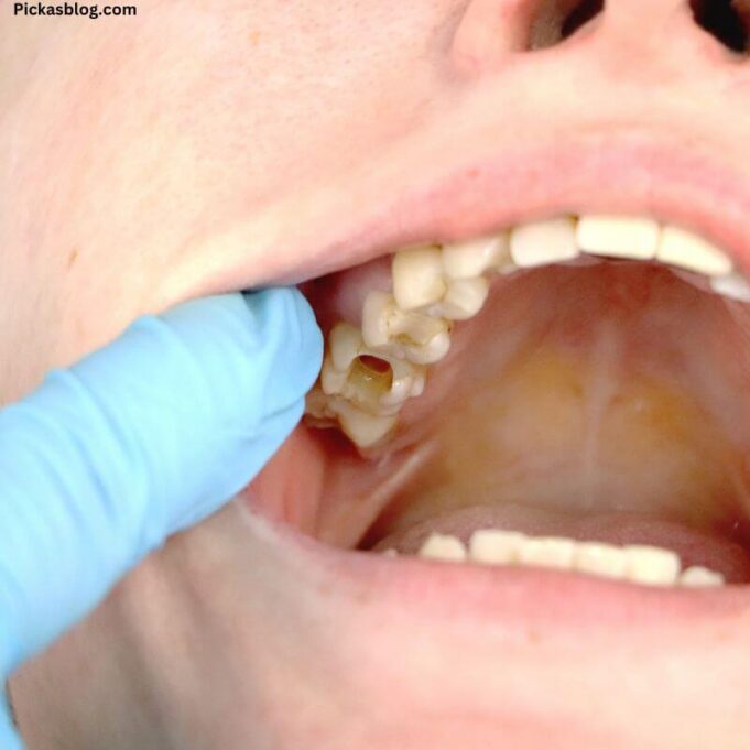 How can I Stop Skin from Peeling Inside my Mouth? How can I Stop Skin from Peeling Inside my Mouth?