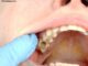 How can I Stop Skin from Peeling Inside my Mouth? How can I Stop Skin from Peeling Inside my Mouth?