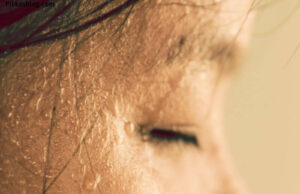What Causes Excessive Sweating of the Head And Face What Causes Excessive Sweating of the Head And Face