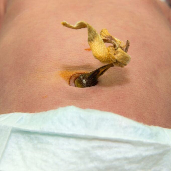 What Happens If You Don’t Cut The Umbilical Cord What Happens If You Don’t Cut The Umbilical Cord