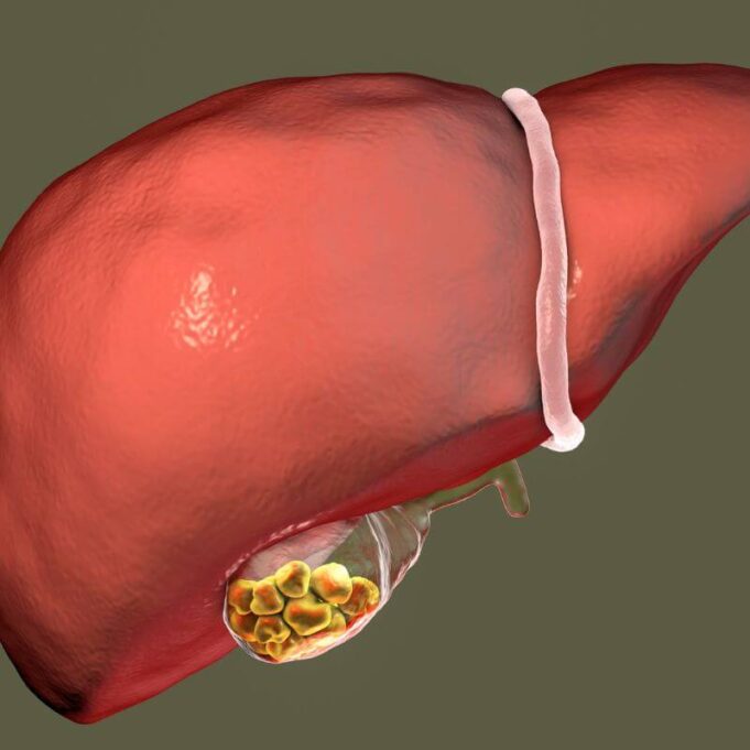 What Happens if Gallbladder Stones Are Not Removed What Happens if Gallbladder Stones Are Not Removed