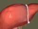 What Happens if Gallbladder Stones Are Not Removed What Happens if Gallbladder Stones Are Not Removed