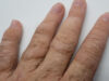 What Happens if a Skin Graft Dies What Happens if a Skin Graft Dies