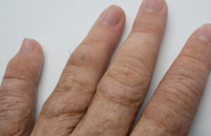 What Happens if a Skin Graft Dies What Happens if a Skin Graft Dies