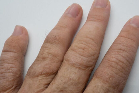 What Happens if a Skin Graft Dies What Happens if a Skin Graft Dies