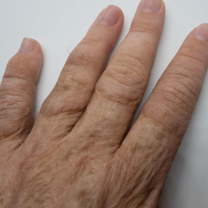 What Happens if a Skin Graft Dies What Happens if a Skin Graft Dies