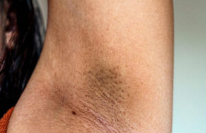 Does Waxing Reduce Dark Underarms Does Waxing Reduce Dark Underarms