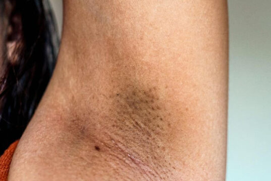 Does Waxing Reduce Dark Underarms Does Waxing Reduce Dark Underarms
