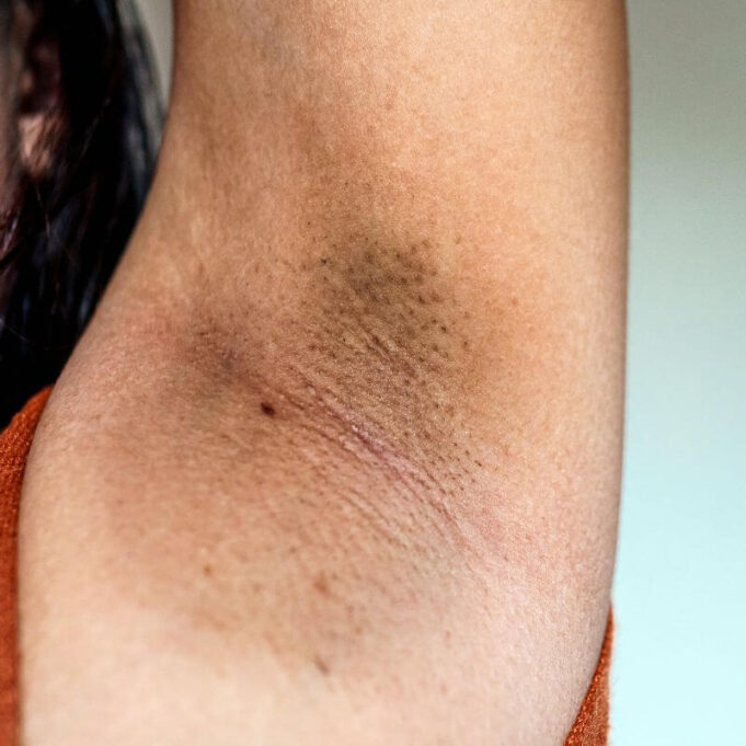 Does Waxing Reduce Dark Underarms Does Waxing Reduce Dark Underarms