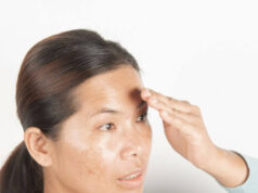 How to Clear Black Acne Marks on the Face How to Clear Black Acne Marks on the Face