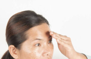 How to Clear Black Acne Marks on the Face How to Clear Black Acne Marks on the Face
