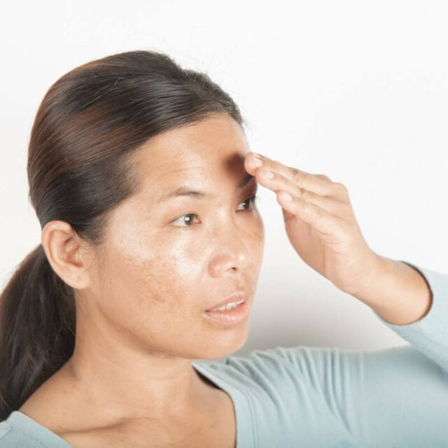 How to Clear Black Acne Marks (1) How to Clear Black Acne Marks on the Face