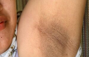 How to Clear Dark Armpits How to Clear Dark Armpits