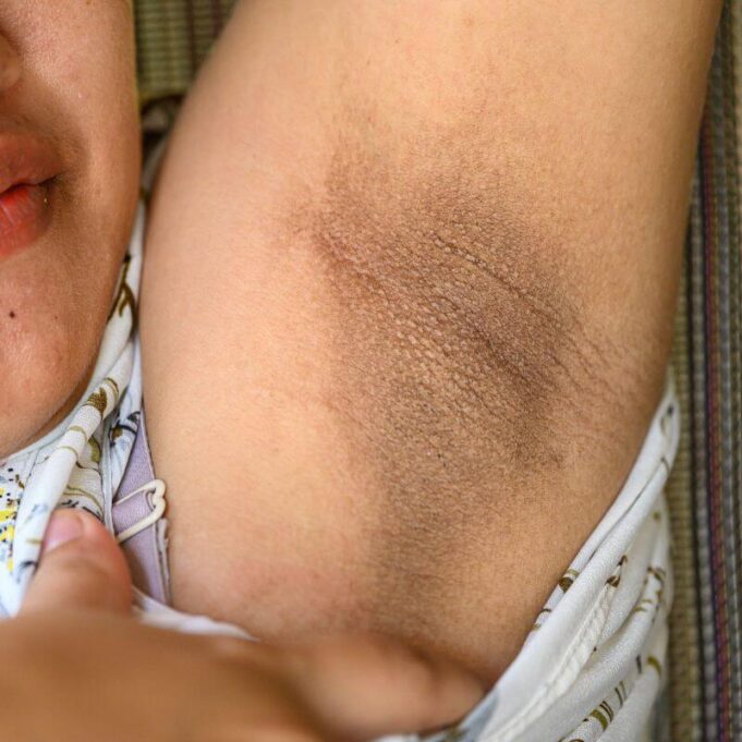 How to Clear Dark Armpits How to Clear Dark Armpits