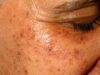 How to Clear Dark Spots on the Face How to Clear Dark Spots on the Face