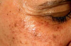 How to Clear Dark Spots on the Face How to Clear Dark Spots on the Face