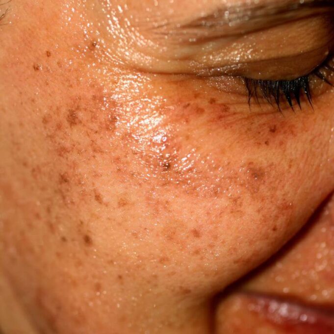 How to Clear Dark Spots on the Face How to Clear Dark Spots on the Face
