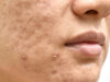How to Fight Pimples and Acne How to Fight Pimples and Acne