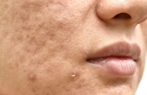 How to Fight Pimples and Acne How to Fight Pimples and Acne