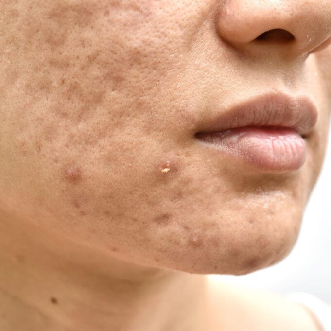 How to Fight Pimples and Acne How to Fight Pimples and Acne