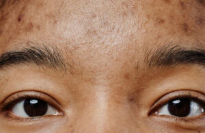 How to Get Rid of Black Spots Caused by Acne How to Get Rid of Black Spots Caused by Acne